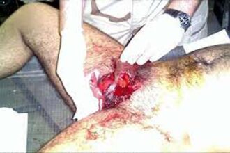 Man Cut off His Pennis