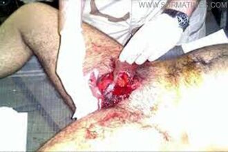 Man Cut off His Pennis