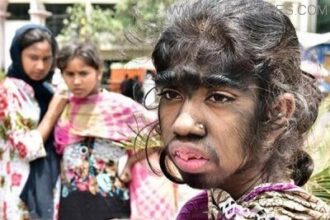 অদ্ভূত রোগে আক্রান্ত টাঙ্গাইলের বীথি : স্তনের ভারে ওষ্ঠাগত জীবন, পুরো শরীর পশমে ঢাকা - Surma Times Archive